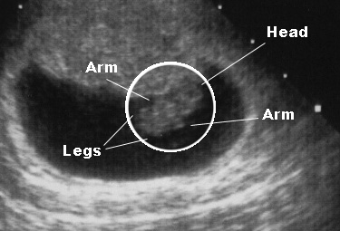 sonogram picture