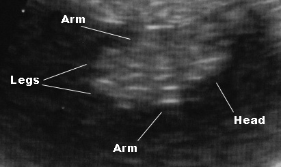 sonogram picture